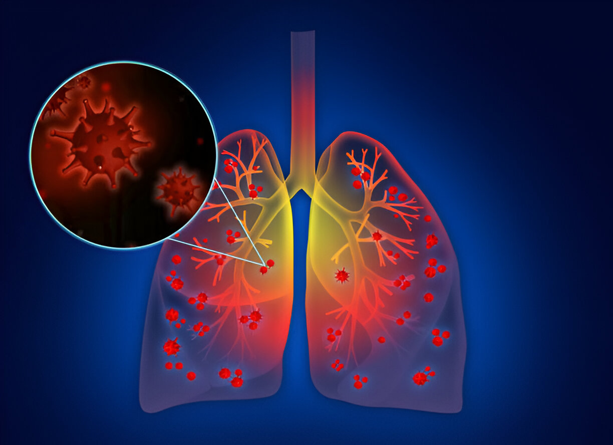 Best Doctor for Lung & Respiratory infections in South Mumbai
